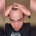 FEG Hair Growth Spray – Stop Hair Fall & Regrow Hair Fast